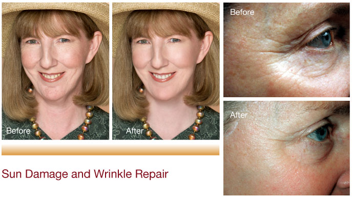 Sun Damage and Wrinkle Repair